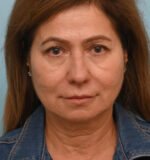 Face Lift/ Neck Lift