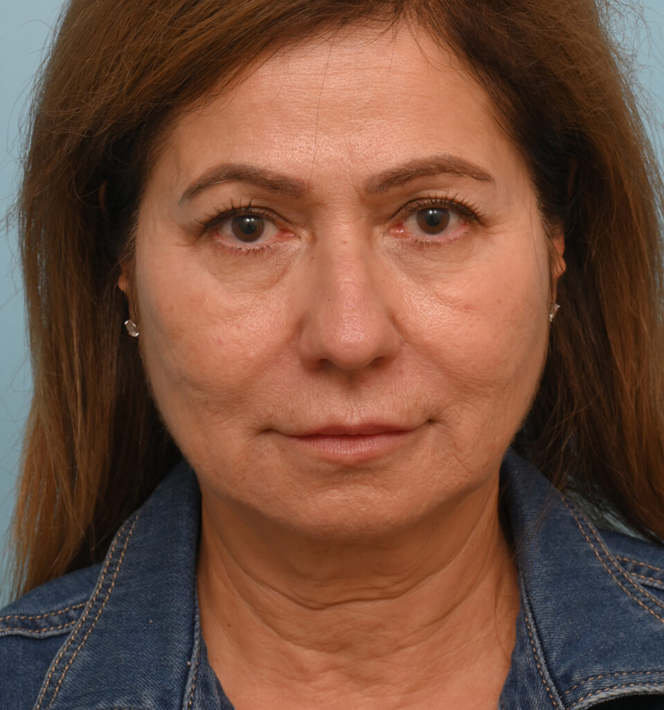 Face Lift/ Neck Lift