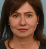 Face Lift/ Neck Lift