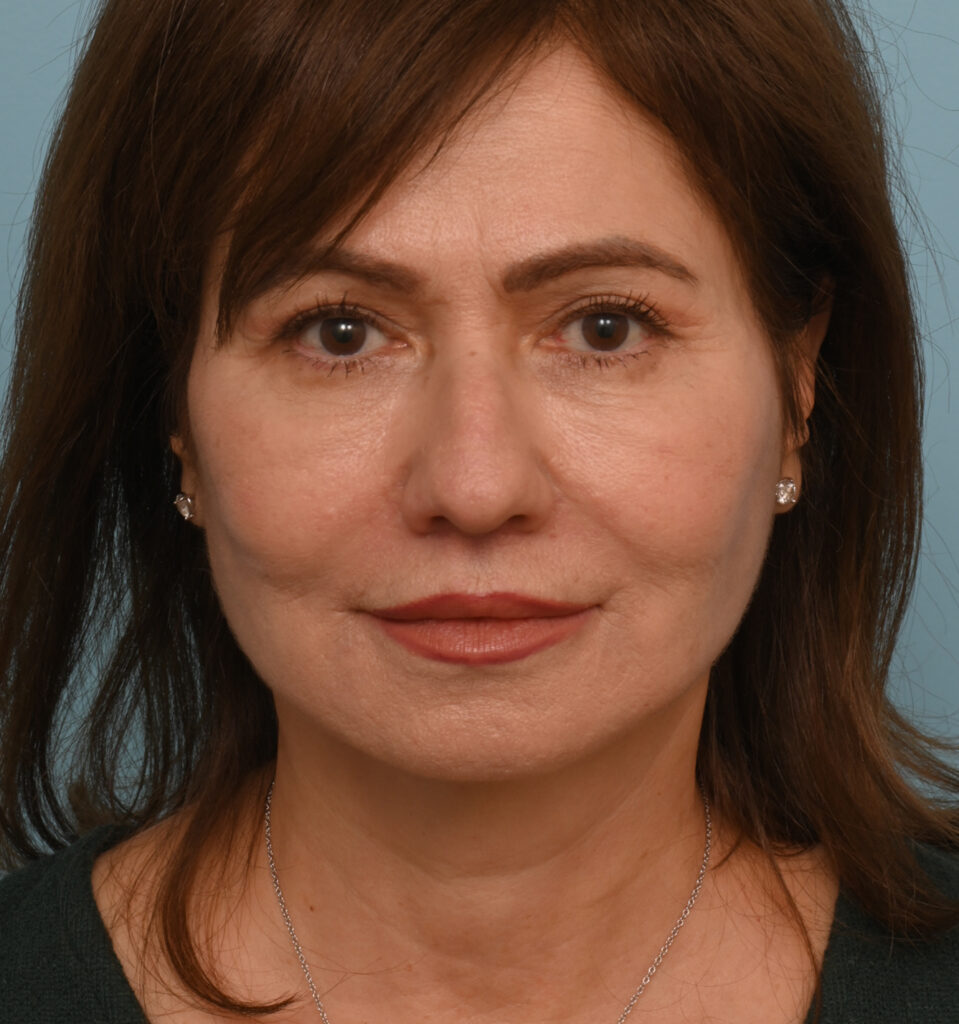 Face Lift/ Neck Lift