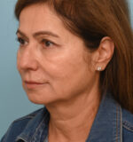 Face Lift/ Neck Lift