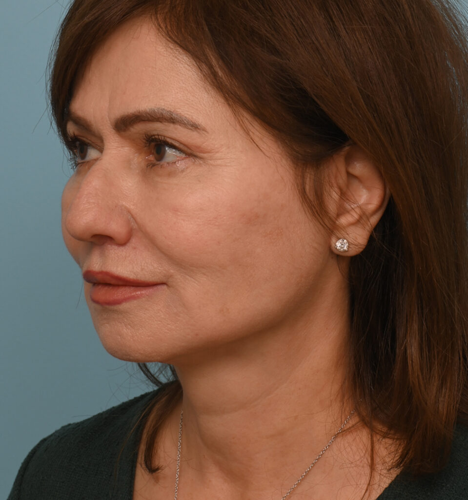 Face Lift/ Neck Lift