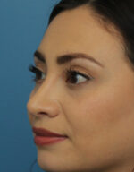 Rhinoplasty