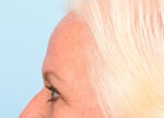 Brow Lift