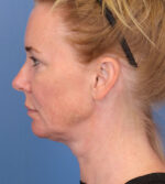 Face Lift/ Neck Lift
