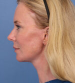Face Lift/ Neck Lift