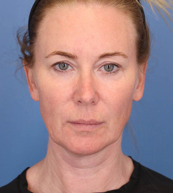 Face Lift/ Neck Lift