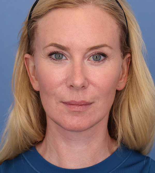 Face Lift/ Neck Lift