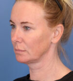 Face Lift/ Neck Lift