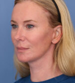 Face Lift/ Neck Lift