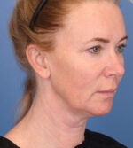 Face Lift/ Neck Lift