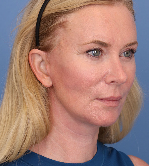 Face Lift/ Neck Lift