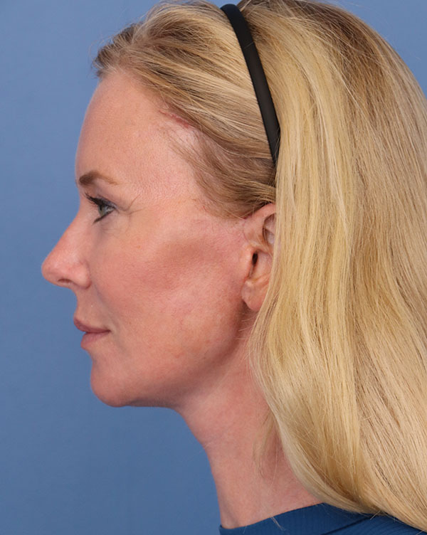 Facial Fat Transfer