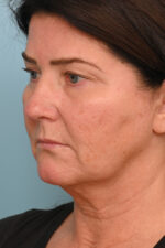 Face Lift/ Neck Lift