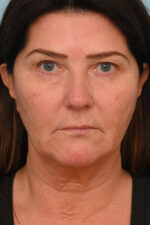 Face Lift/ Neck Lift