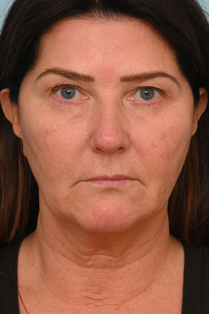 Face Lift/ Neck Lift