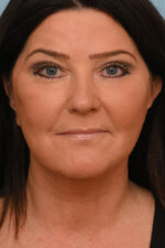 Face Lift/ Neck Lift
