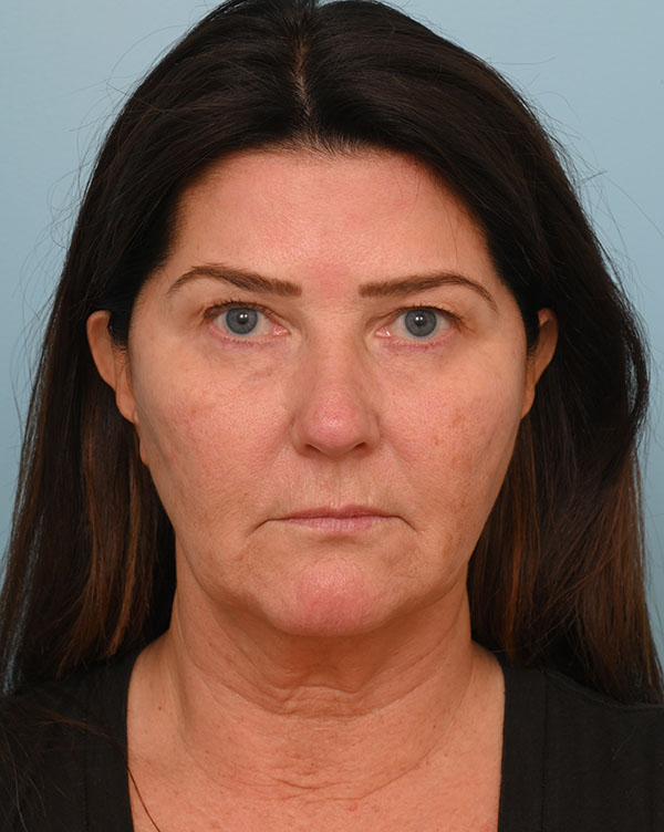 Facial Fat Transfer