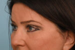 Eye Rejuvenation