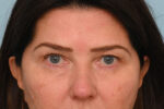 Eye Rejuvenation