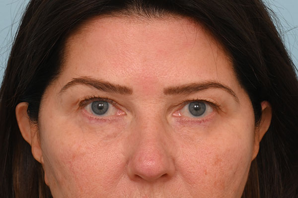 Eye Rejuvenation