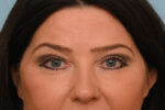 Eye Rejuvenation