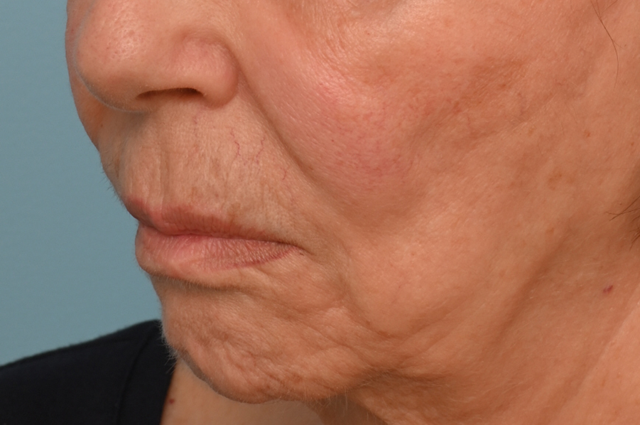 Lip Lift
