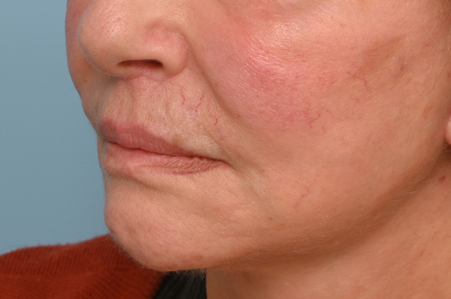 Lip Lift