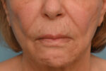 Lip Lift
