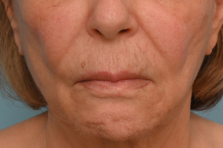 Lip Lift