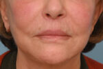 Lip Lift