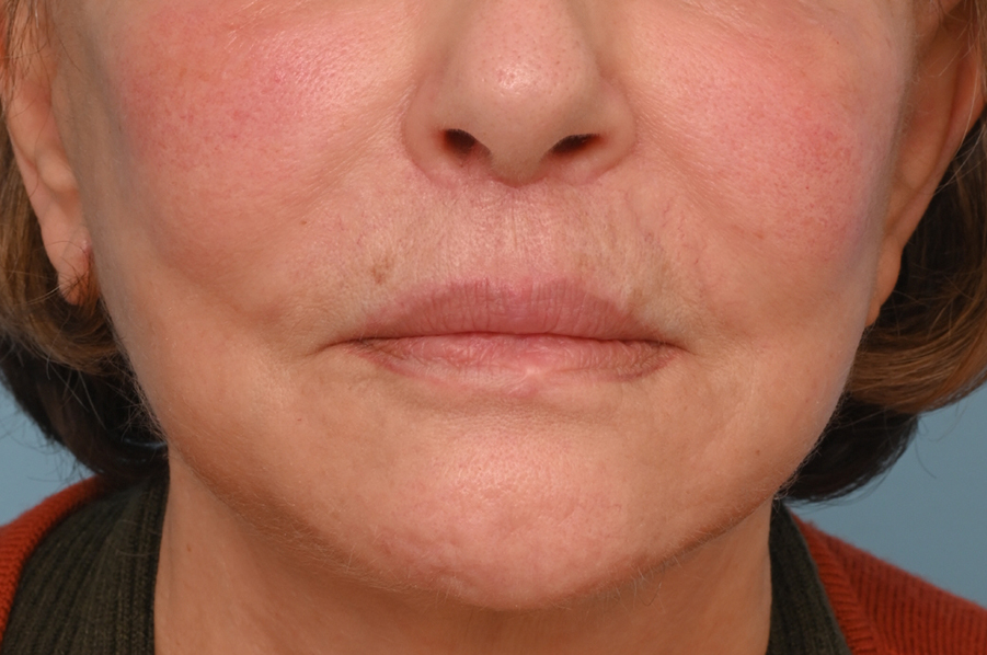 Lip Lift