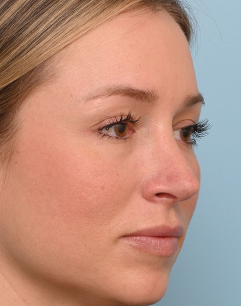 Rhinoplasty