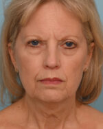 Face Lift/ Neck Lift