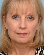 Face Lift/ Neck Lift