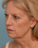 Face Lift/ Neck Lift