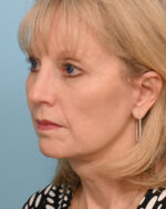 Face Lift/ Neck Lift