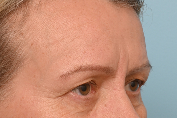 Brow Lift