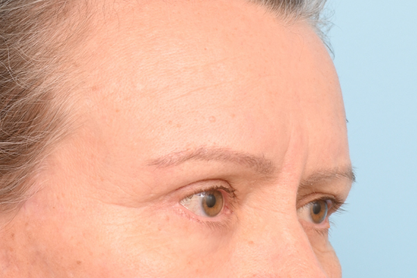 Brow Lift