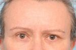 Brow Lift