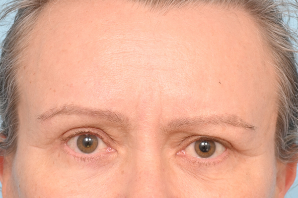Brow Lift