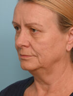 Face Lift/ Neck Lift