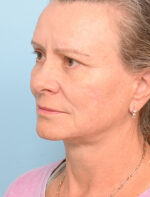 Face Lift/ Neck Lift