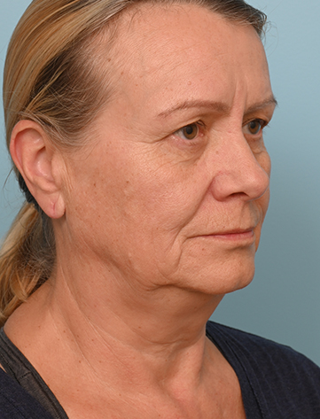 Face Lift/ Neck Lift
