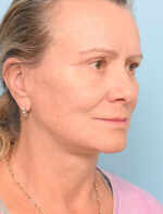 Face Lift/ Neck Lift