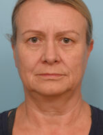 Face Lift/ Neck Lift