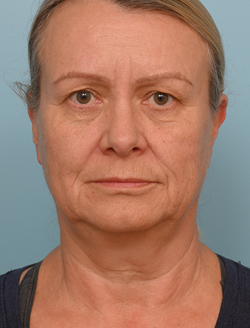 Face Lift/ Neck Lift