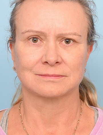 Face Lift/ Neck Lift