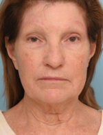 Face Lift/ Neck Lift