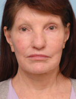 Face Lift/ Neck Lift
